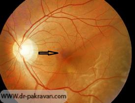 چشم‌پزشک با استفاده از لنزهای مخصوص قادر به بررسی وجود و شدت جداشدگی شبکیه می‌باشد.